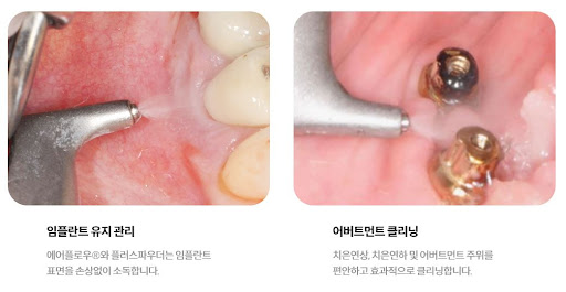 불당본점 서울비디치과의원에서 제공하는 천안 임플란트와 치아교정의 안전성과 효과 검토