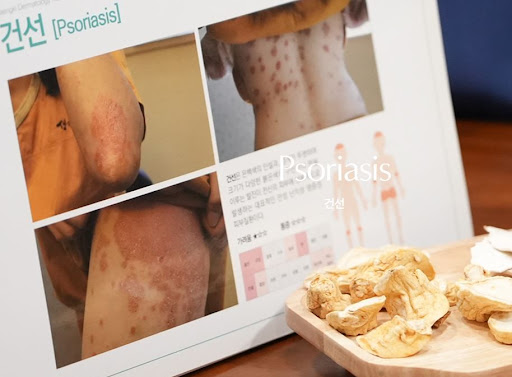 생기한의원이 안내하는 건선 상담 전 복용약 정리 이유